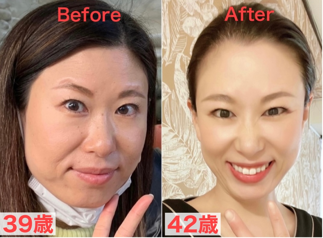 エラ顔矯正を3回実施した結果