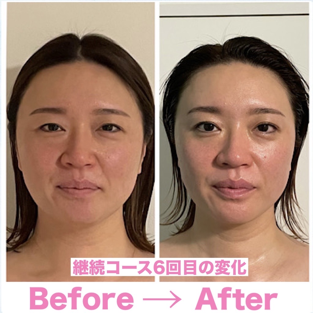 たるみ顔の施術を10回実施した結果